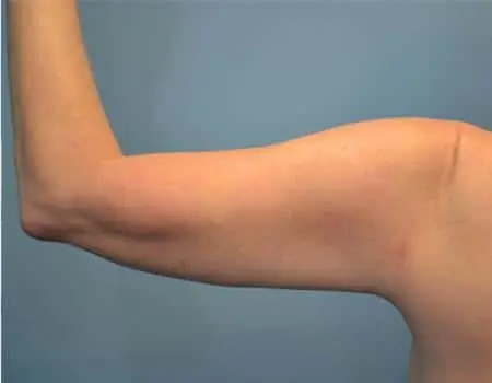 Smartlipo Before & After Case 4286
