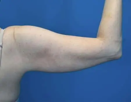 Smartlipo Before & After Case 4286