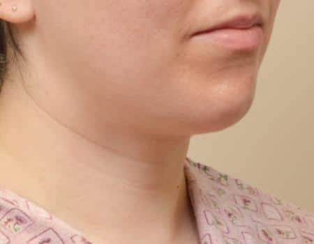 Smartlipo Before & After Case 4272