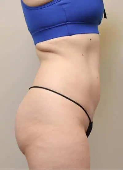 Smartlipo Before & After Case 4265