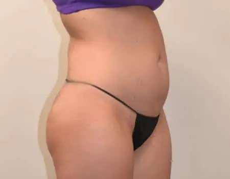 Smartlipo Before & After Case 4258