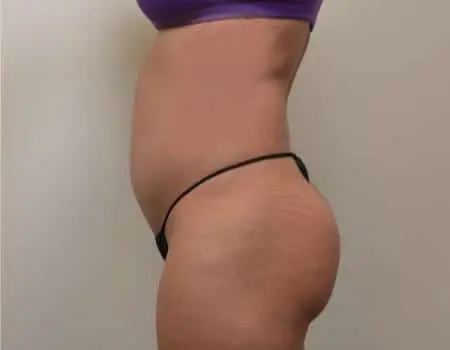 Smartlipo Before & After Case 4258