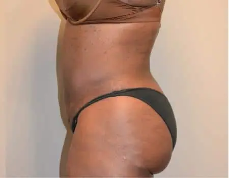 Smartlipo Before & After Case 4225