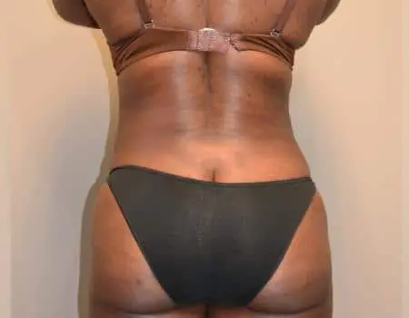 Smartlipo Before & After Case 4225