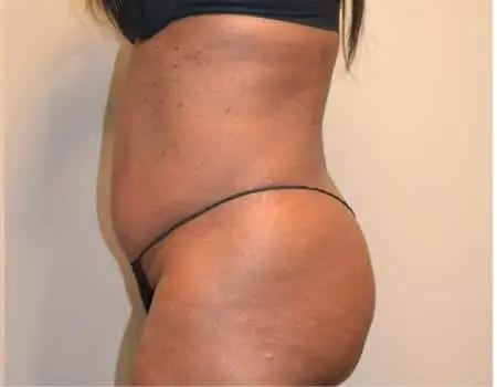 Smartlipo Before & After Case 4225