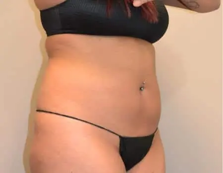 Smartlipo Before & After Case 4218