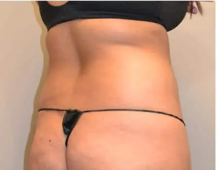 Smartlipo Before & After Case 4218