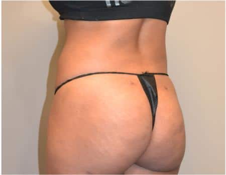 Smartlipo Before & After Case 4211