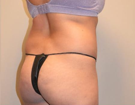 Smartlipo Before & After Case 4211