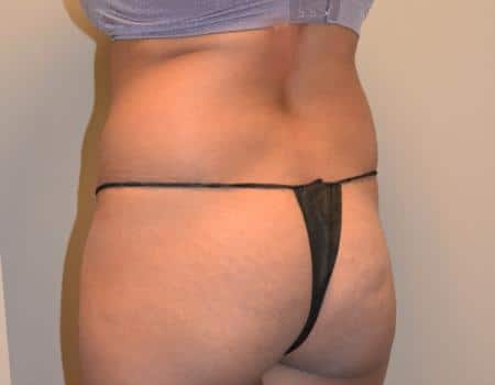 Smartlipo Before & After Case 4211