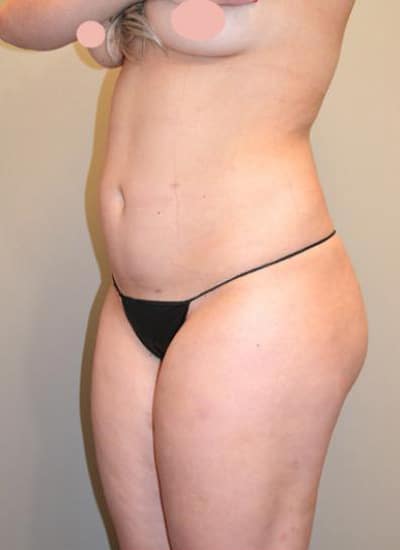 Smartlipo Before & After Case 4200