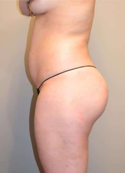 Smartlipo Before & After Case 4200