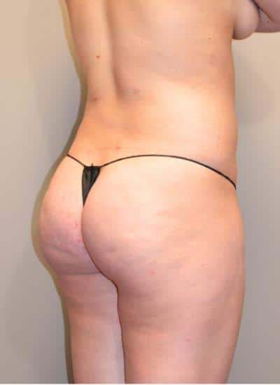 Smartlipo Before & After Case 4200