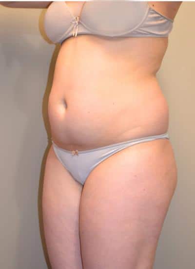 Smartlipo Before & After Case 4200