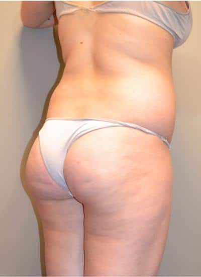 Smartlipo Before & After Case 4200