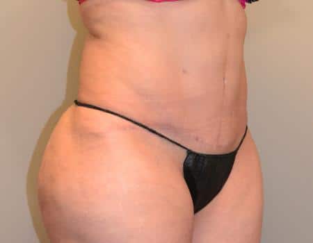 Smartlipo Before & After Case 4193