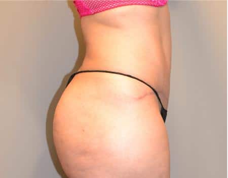 Smartlipo Before & After Case 4193