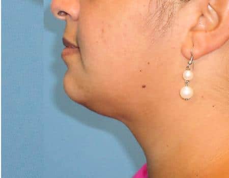Smart Lipo Before & After Before & After Case 4184