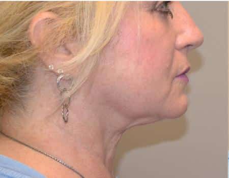 Smartlipo Before & After Case 4165