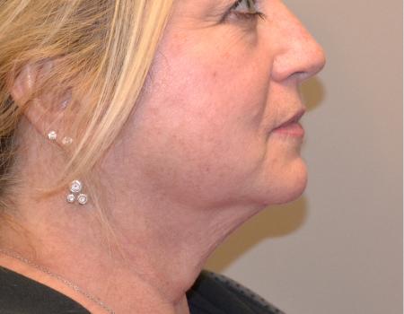 Smartlipo Before & After Case 4165