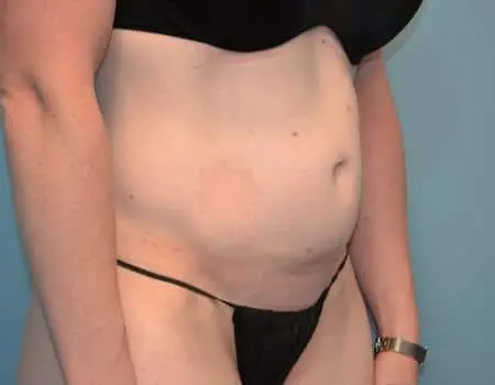 Smartlipo Before & After Case 4151