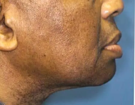Smartlipo Before & After Case 4316