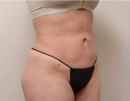 Smartlipo Before & After Case 4309