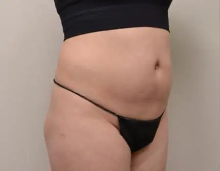 Smartlipo Before & After Case 4309