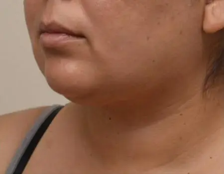 Smartlipo Before & After Case 4302