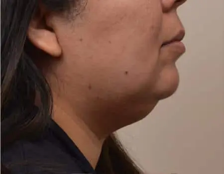 Smartlipo Before & After Case 4302