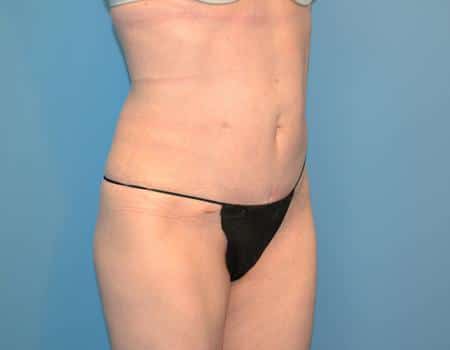 Smartlipo Before & After Case 4344