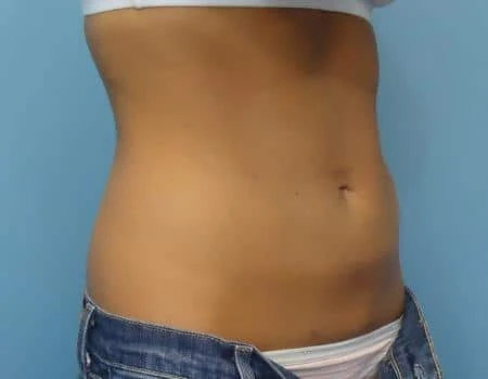 Smartlipo Before & After Case 4337