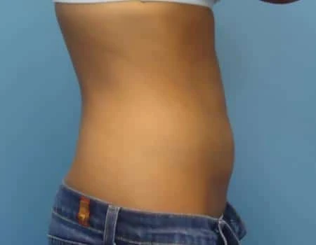 Smartlipo Before & After Case 4337