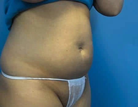 Smartlipo Before & After Case 4337