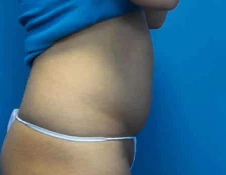 Smartlipo Before & After Case 4337