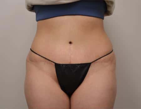Tummy Tuck Before & After Case 3807