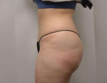 Tummy Tuck Before & After Case 3807