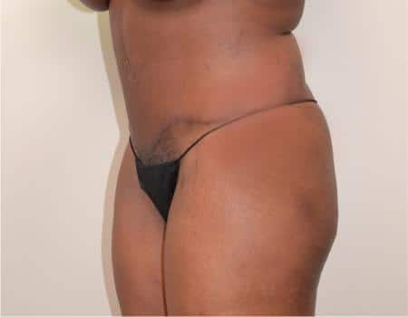 Tummy Tuck Before & After Case 3800