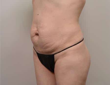 Tummy Tuck Before & After Case 3793