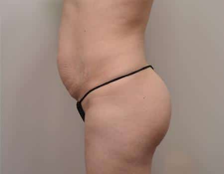 Tummy Tuck Before & After Case 3793