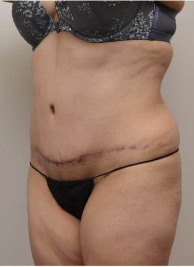 Tummy Tuck Before & After Case 3786