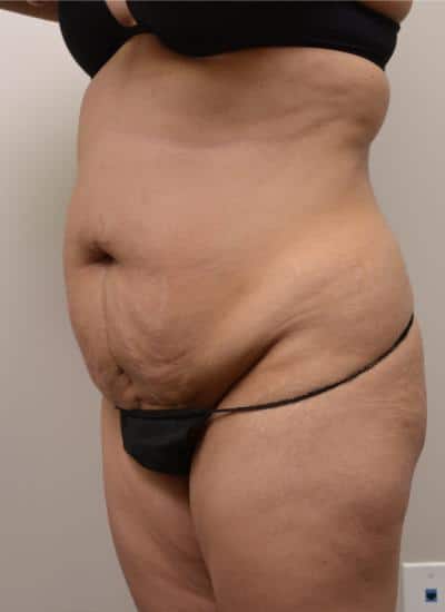 Tummy Tuck Before & After Case 3786