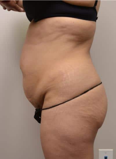 Tummy Tuck Before & After Case 3786