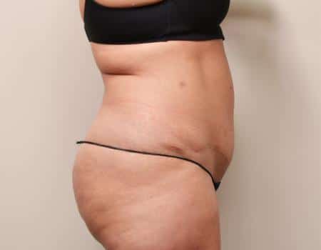 Tummy Tuck Before & After Case 3779