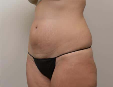Tummy Tuck Before & After Case 3765