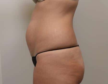 Tummy Tuck Before & After Case 3765