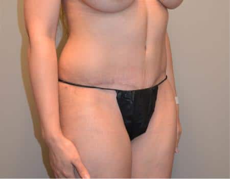 Tummy Tuck Before & After Case 3758