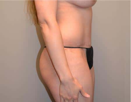 Tummy Tuck Before & After Case 3758