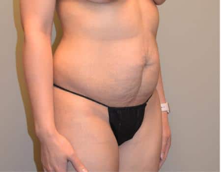 Tummy Tuck Before & After Case 3758
