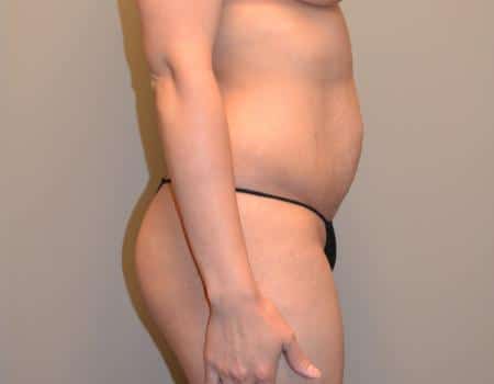 Tummy Tuck Before & After Case 3758